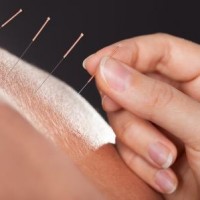 Alternativ behandling med akupunktur